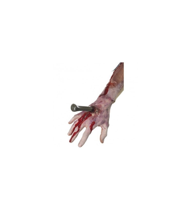Kůl skrz ruku - nalepovací zranění